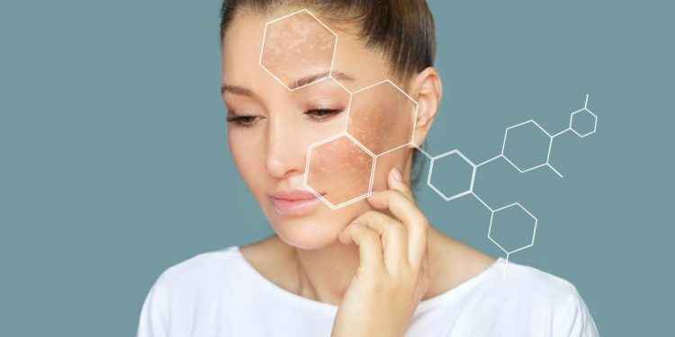 ¿Cuál es el mejor tratamiento de las manchas hormonales o melasma?