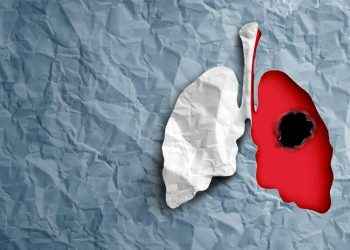 Cinco datos clave en cáncer de pulmón