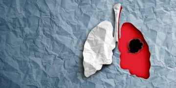 Cinco datos clave en cáncer de pulmón