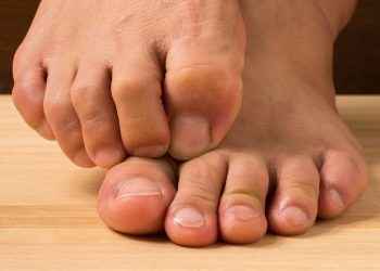 Uñas encarnadas (onicocriptosis)