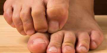 Uñas encarnadas (onicocriptosis)