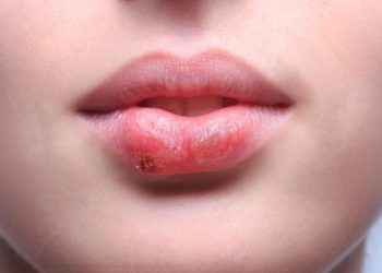 Herpes labial