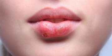 Herpes labial