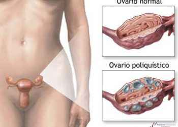 Detección tardía Síndrome Ovario Poliquístico podría causar infertilidad en las mujeres