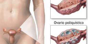 Detección tardía Síndrome Ovario Poliquístico podría causar infertilidad en las mujeres