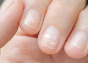 Manchas blancas en las uñas, ¿a qué se deben?