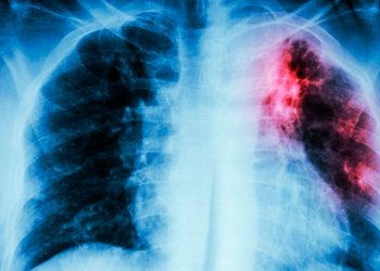 Doctora Pérez: Tuberculosis sigue siendo una de las causas más frecuentes de mortalidad en el mundo