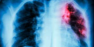 Doctora Pérez: Tuberculosis sigue siendo una de las causas más frecuentes de mortalidad en el mundo