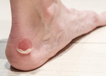 Rozaduras en los pies: así puedes curar y prevenir las ampollas