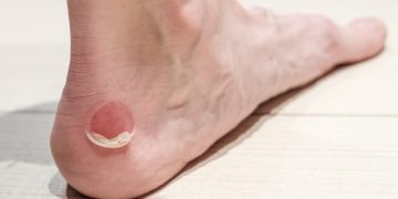 Rozaduras en los pies: así puedes curar y prevenir las ampollas