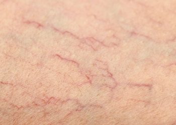 ¿En qué se diferencian las arañas vasculares de las varices?