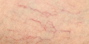 ¿En qué se diferencian las arañas vasculares de las varices?