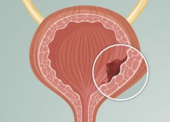 Cómo prevenir el cáncer de vejiga