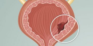 Cómo prevenir el cáncer de vejiga