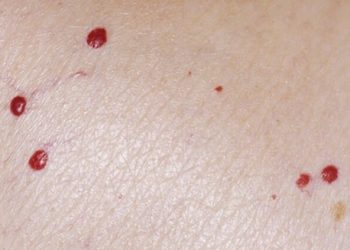 Por qué aparecen puntos rojos similares a los lunares