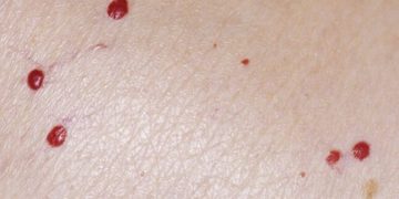 Por qué aparecen puntos rojos similares a los lunares
