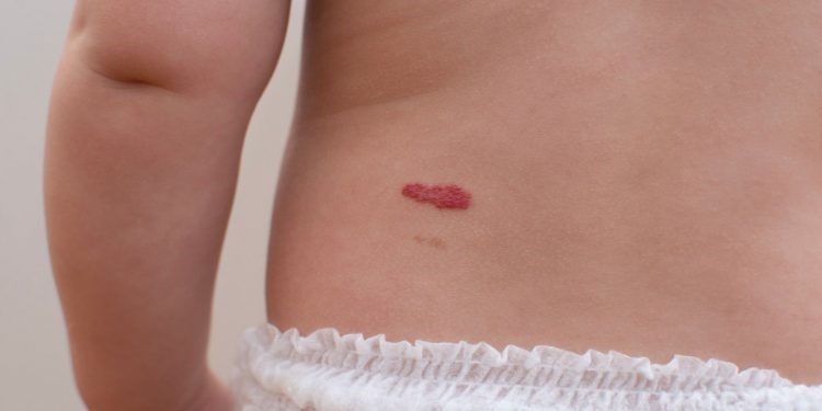 Hemangiomas infantiles: cómo elegir el mejor tratamiento