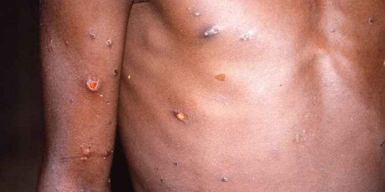 Cómo se contagia la viruela del mono y cuáles son los síntomas para detectarla