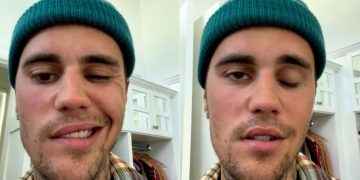Justin Bieber confesó que sufre de parálisis en la mitad del rostro por un virus: “Es muy grave”