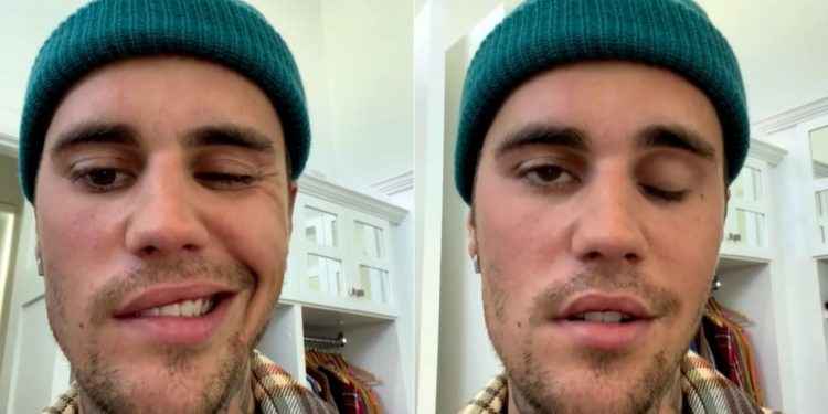 Justin Bieber confesó que sufre de parálisis en la mitad del rostro por un virus: “Es muy grave”