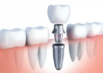 Seis mitos sobre los implantes dentales