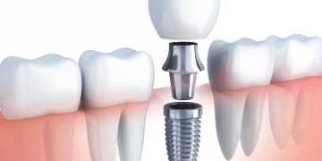 Seis mitos sobre los implantes dentales