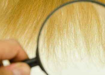 Así es el síndrome del pelo impeinable
