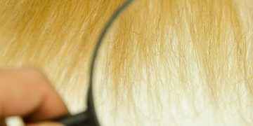 Así es el síndrome del pelo impeinable