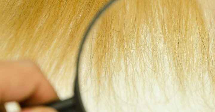 Así es el síndrome del pelo impeinable