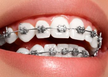 ¿Cómo es la ortodoncia en pacientes con implantes dentales?