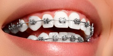 ¿Cómo es la ortodoncia en pacientes con implantes dentales?