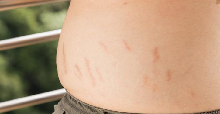 Estrías en hombres: causas y cómo reducirlas naturalmente