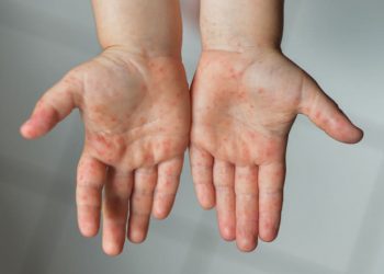 Viruela del mono en niños: cuáles son los síntomas y cómo se trata