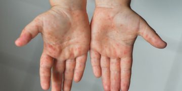 Viruela del mono en niños: cuáles son los síntomas y cómo se trata