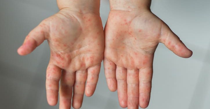 Viruela del mono en niños: cuáles son los síntomas y cómo se trata