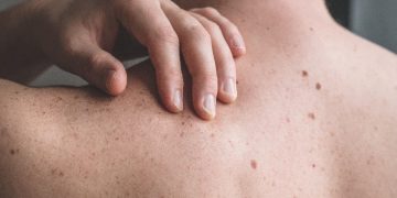 10 conclusiones sobre el cáncer de piel