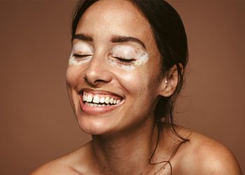 Vitíligo, un problema de la piel que va mucho más allá de la estética