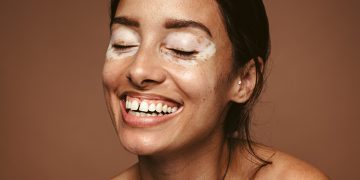 Vitíligo, un problema de la piel que va mucho más allá de la estética