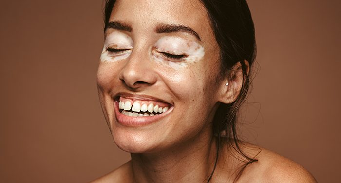 Vitíligo, un problema de la piel que va mucho más allá de la estética