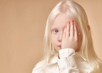 Albinismo: así afecta a la visión y a la piel