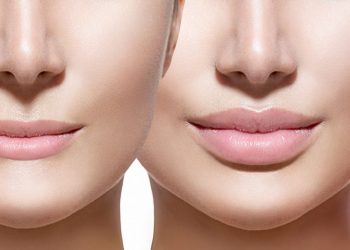 Todo sobre el aumento de labios: precio, metodología, consejos…