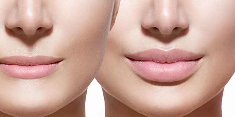 Todo sobre el aumento de labios: precio, metodología, consejos…