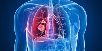 Cáncer de pulmón: cómo detectarlo a tiempo