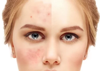 BULO BEAUTY: «No deberías maquillarte si tienes acné»