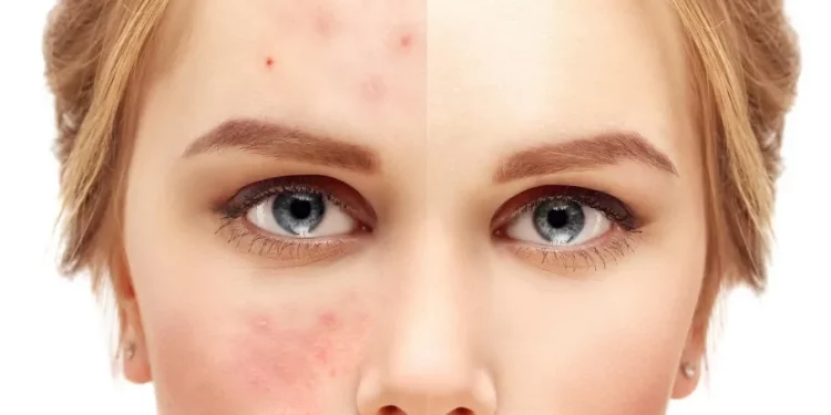 BULO BEAUTY: «No deberías maquillarte si tienes acné»