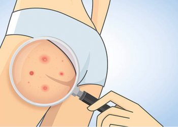 Por qué ahora también tienes acné en los glúteos