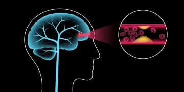 Los tres síntomas clave que avisan de un posible ictus