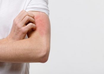 Estos son los 5 productos que provocan alergias a tu piel