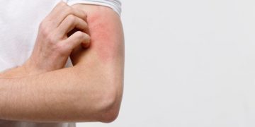 Estos son los 5 productos que provocan alergias a tu piel