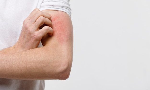 Estos son los 5 productos que provocan alergias a tu piel